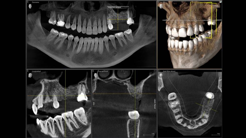Sample CBCT output: panoramic, 3D, longitudinal, cross-sectional and axial views from a Sirona Orthophos SL scan